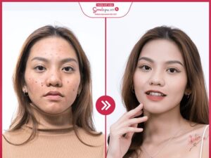 Seoulspa Long Xuyên mang lại hiệu quả điều trị mụn tích cực