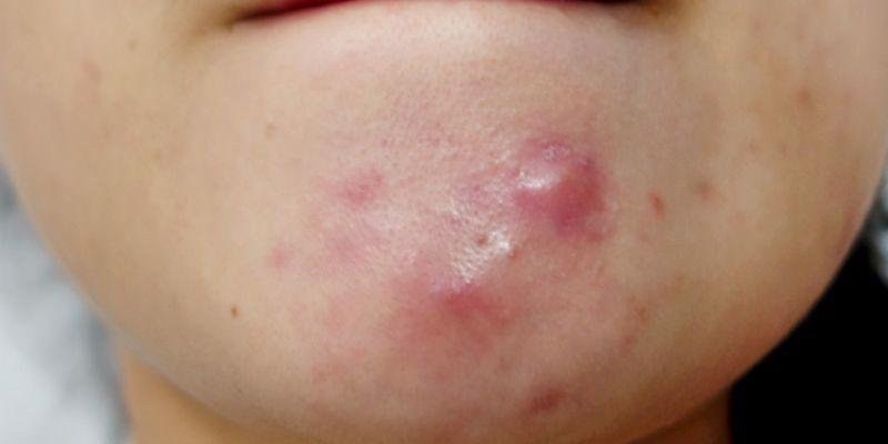 Benzoyl peroxide giúp các nốt mụn nang giảm viêm, giảm sưng nhanh chóng