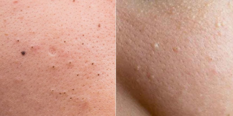 Sử dụng Benzoyl peroxide trị mụn đầu đen, đầu trắng dễ dàng chỉ trong thời gian ngắn