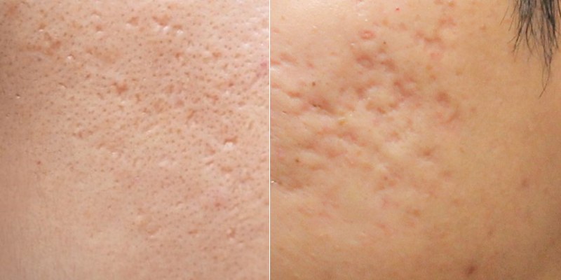 Benzoyl peroxide còn có khả năng lắp đầy sẹo mụn nhờ cơ chế tái tạo tế bào, tăng sinh collagen nhanh chóng