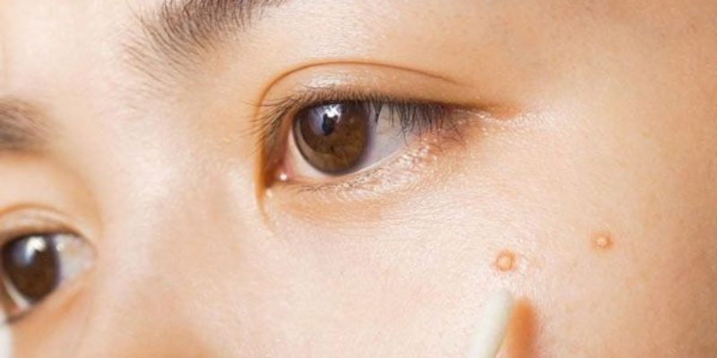 Chấm Benzoyl peroxide giúp mụn gom cồi mụn nhanh chóng