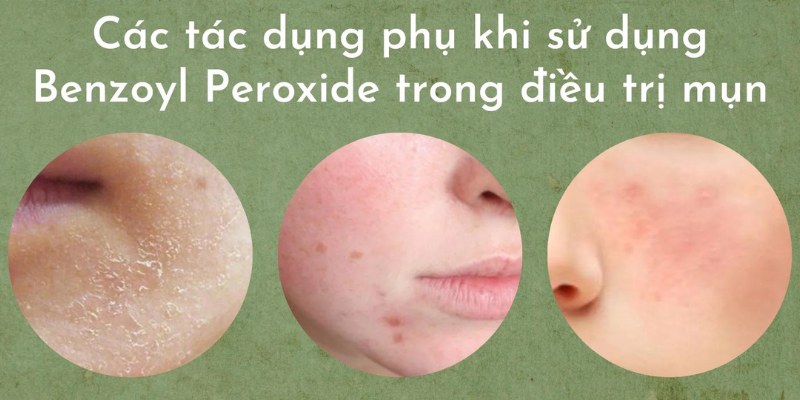Một số tác dụng phụ cần ghi nhớ khi sử dụng Benzoyl peroxide trị mụn