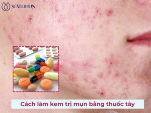 Cách làm kem trị mụn bằng thuốc tây đem lại hiệu quả quả ấn tượng