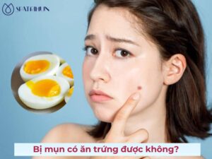 Bị mụn có ăn trứng được không? Cách ăn trứng không lo nổi mụn