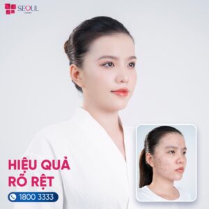 Hiệu quả trị mụn rõ rệt sau một liệu trình tại SeoulSpa.Vn Biên Hoà