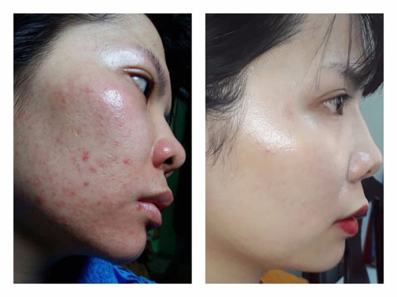 Phòng khám Da liễu huyện Bình Chánh đa khoa Sài Gòn cơ sở 1 trị mụn hiệu quả