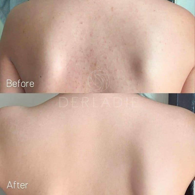 Nina Paris Spa có thể trị cả mụn lưng