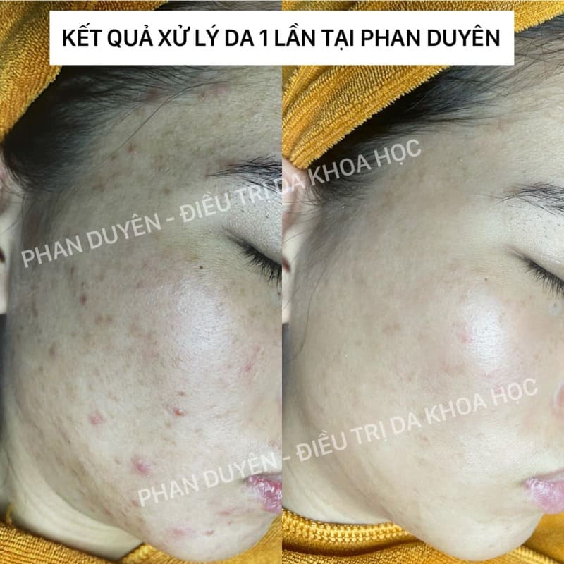 Phan Duyên là địa chỉ điều trị da khoa học