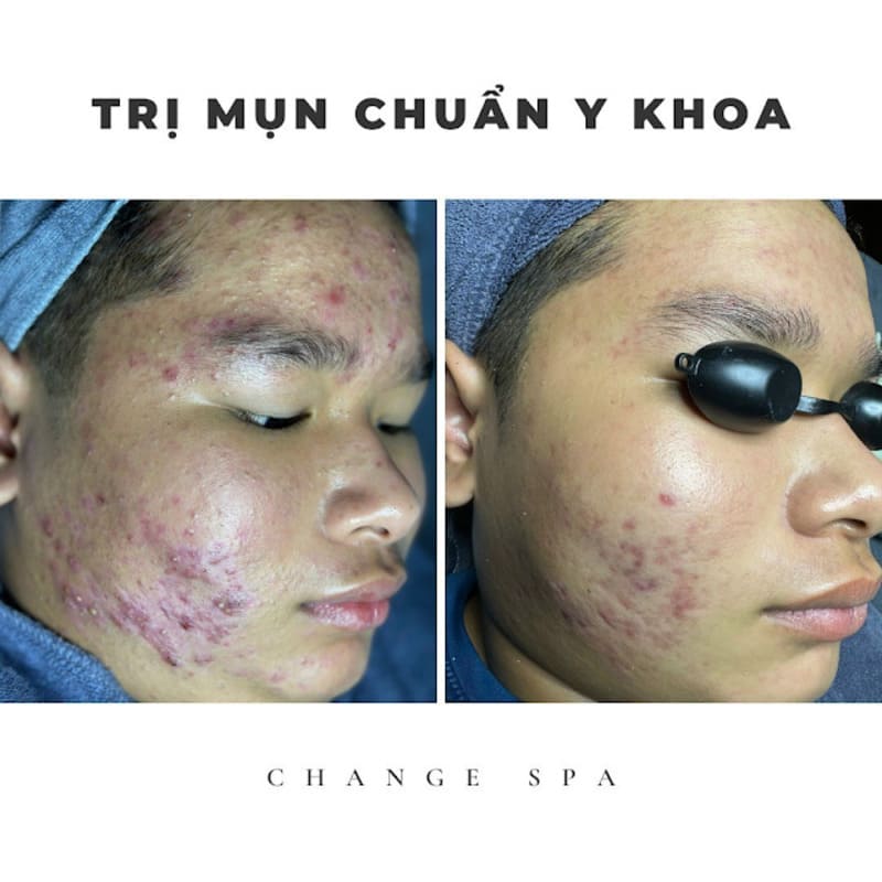 Change Spa Beauty chuyên điều trị mụn chuẩn y khoa