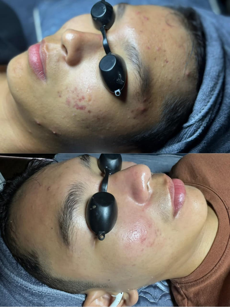 Thanh Beauty Spa là địa chỉ trị mụn uy tín ở Bình Chánh