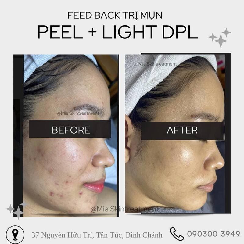 Mia Beauty Spa sử dụng các sản phẩm từ thiên nhiên trong quá trình điều trị mụn