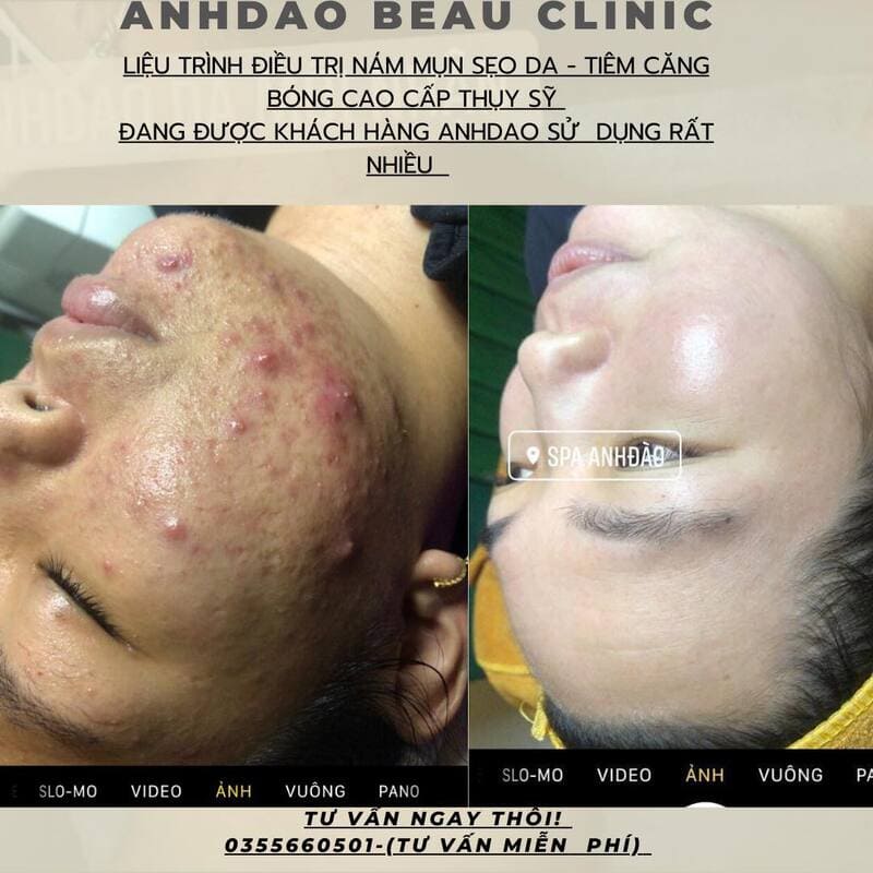 Anh Đào Clinic cam kết mang lại hiệu quả cao trong việc trị mụn