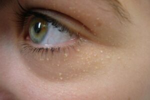 Các nốt mụn đá sẽ có cảm giác cứng khi chạm vào, có thể ảnh hưởng đến thẩm mỹ