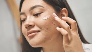 Kết hợp BHA với hoạt chất nào để trị mụn viêm?