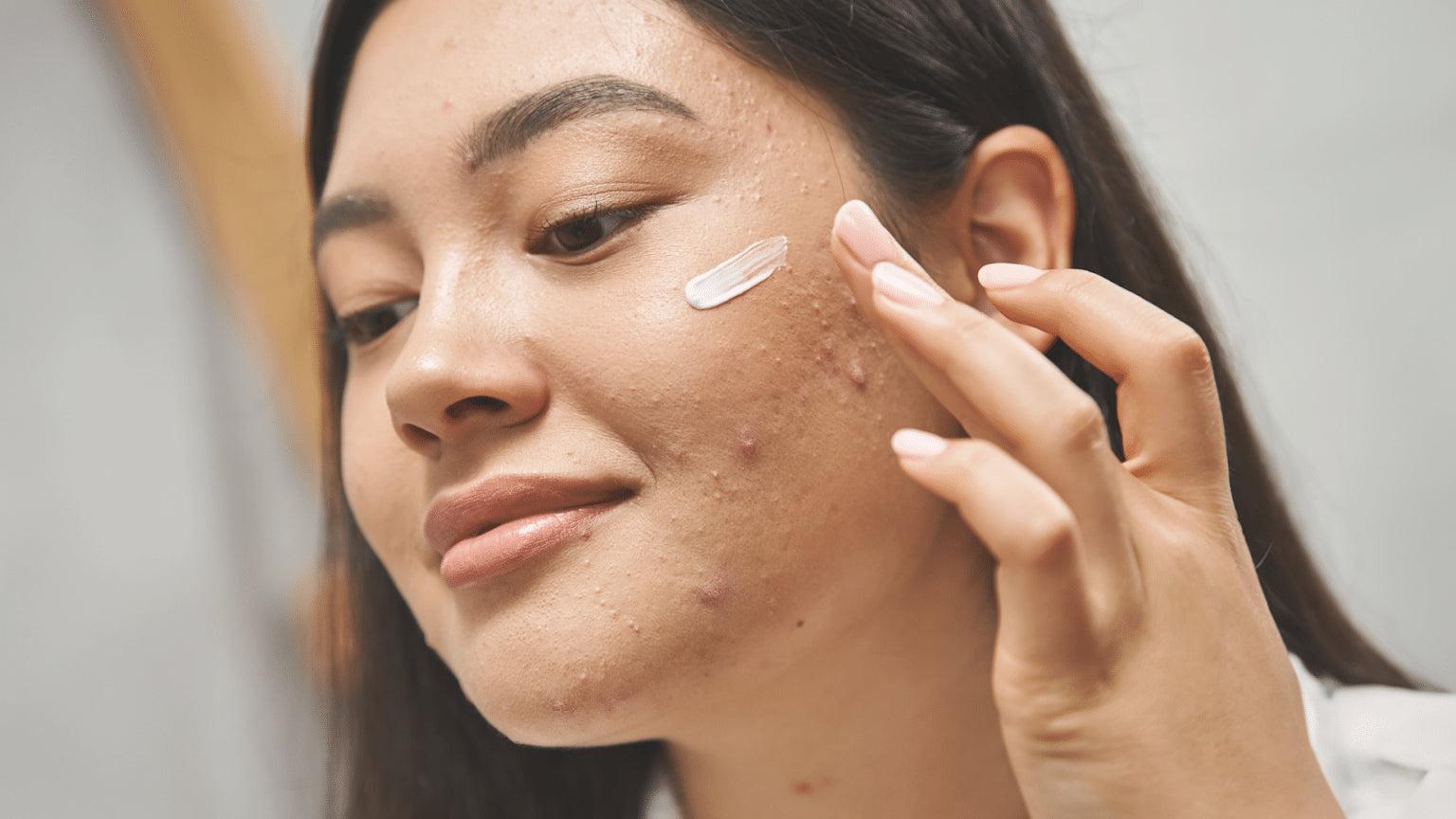 Kết hợp BHA với hoạt chất nào để trị mụn viêm?