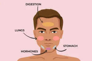 hormonal acne chin treatment