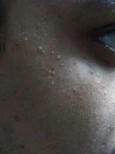 milia skin treatment safety