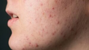mụn comedone kín/mụn ẩn trên da.