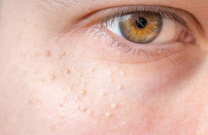 Mụn gạo tự hết ở mỗi độ tuổi khác nhau