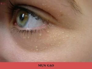 Mụn gạo là gì và tại sao khó tự hết