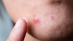 Bao lâu mụn chai mới khỏi với điều trị
