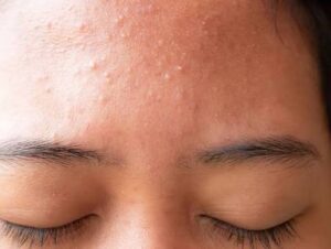 Nguyên nhân chính gây mụn li ti trên trán