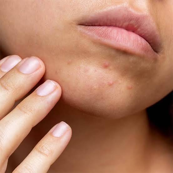 Nguyên nhân nào gây mụn sưng ở cằm?