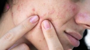 Mụn trứng cá có tự hết không? Tùy loại mụn