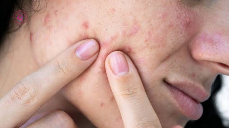 Mụn trứng cá có tự hết không? Tùy loại mụn