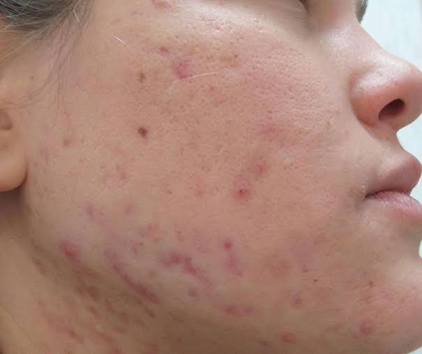 Thâm mụn bao lâu thì hết?