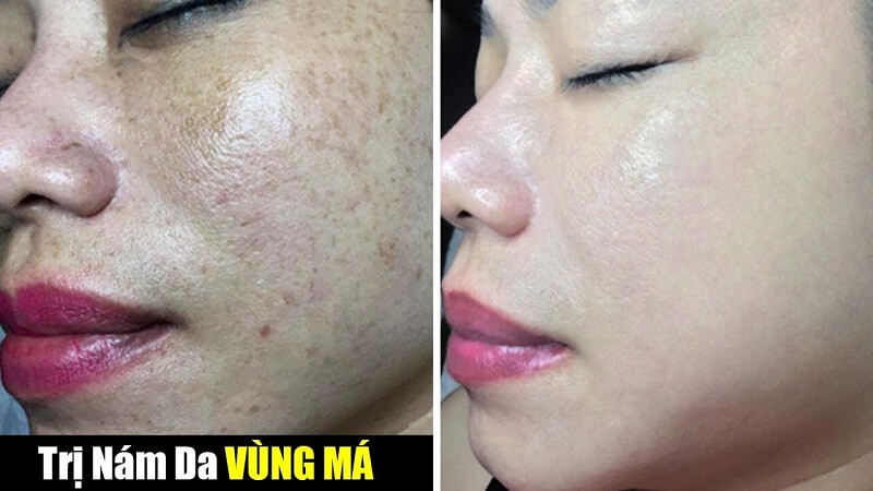 Tiêm Trị Nám Là Gì? Bật Mí Điều Ít Ai Biết Về Tiêm Trị Nám