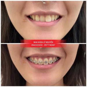 Niềng răng cao cấp tại nha khoa Lê Nguyễn