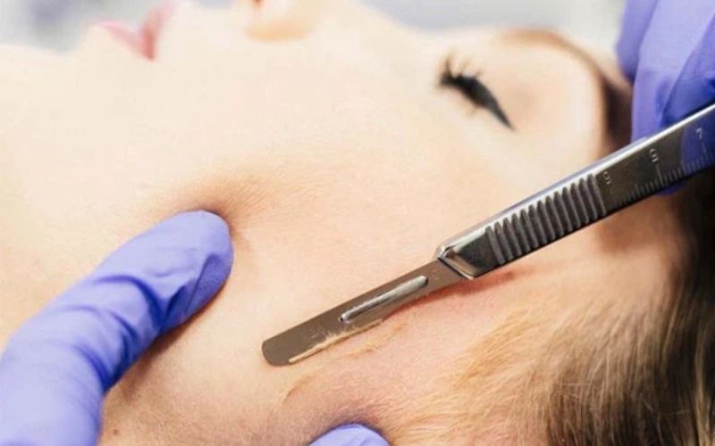 Các bước cạo lông mặt chuẩn Y khoa giúp da không lên mụn