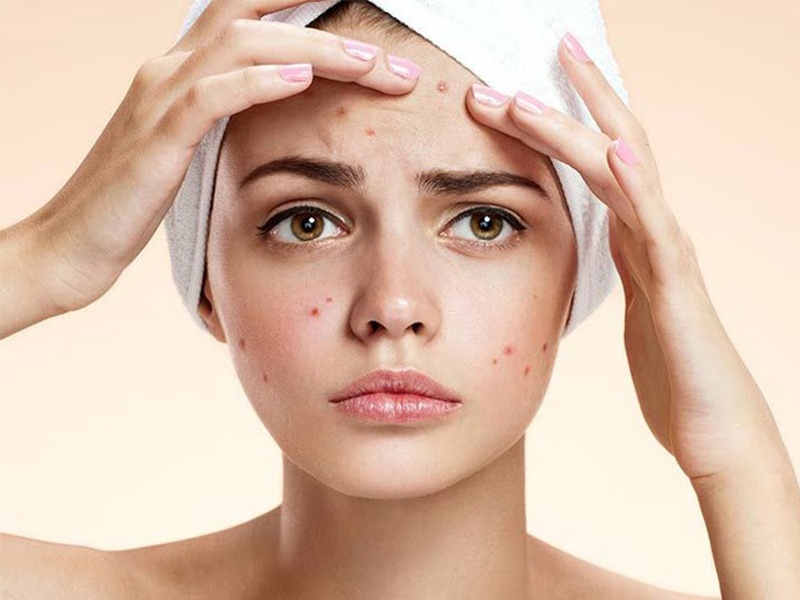 Lựa chọn các sản phẩm dưỡng da chuyên dụng cho da mụn