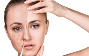 Erythromycin là hoạt chất có trong thuốc trị mụn Medskin Ery