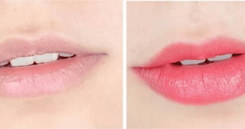 Sau 3–5 ngày, máu hết chảy và vảy bắt đầu tạo thành, bạn mới có thể bình thường trở lại, nhưng vẫn cần cẩn thận.