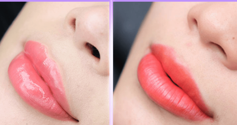 Công nghệ phun môi với igle nano-needle giảm xâm lấn và tổn thương, đảm bảo an toàn trong phun