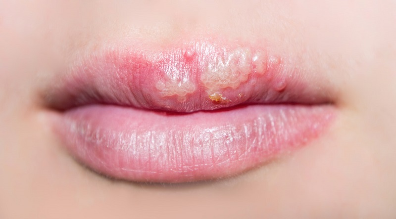 Cách phòng ngừa phun môi bị mụn nước