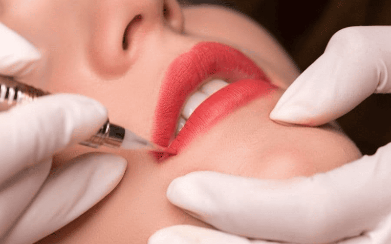 Kỹ thuật phun môi collagen sử dụng đầu kim nano tác động lên lớp thượng bì