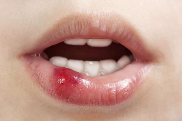 Virus Herpes là nguyên nhân chính gây mụn nước sau phun