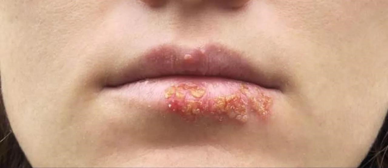 điều trị mụn nước trên môi sau phun xăm