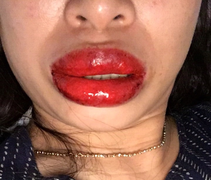 Nếu sưng kéo dài quá 1 tuần mà không có dấu hiệu thuyên giảm nên liên hệ bác sĩ