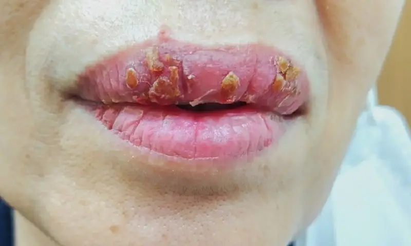 Nếu bạn thấy mủ hoặc dịch lạ, đó có thể là dấu hiệu nhiễm trùng.