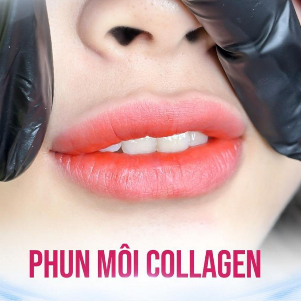 phun môi collagen bền khoảng 2 đến 3 năm, tuy nhiên có thể kéo dài đến 5 năm