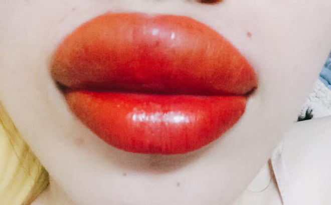 Sưng sau phun môi là hoàn toàn bình thường và được mong đợi