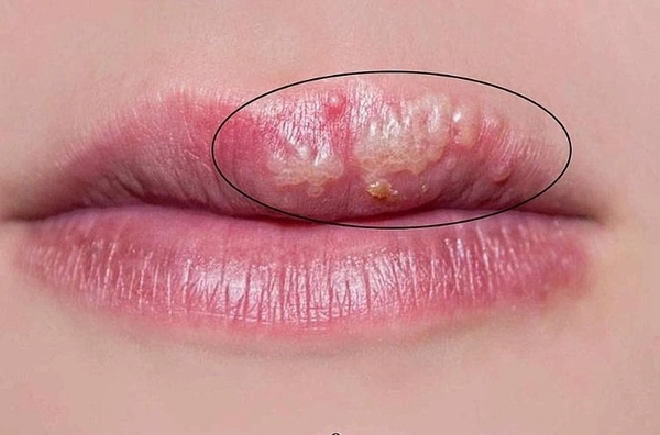 Virus Herpes simplex loại 1 thường gây mụn rộp ở miệng