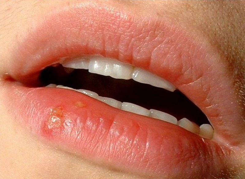Mụn nước thường xuất hiện sau 2-3 ngày phun môi, khi tái tạo da bắt đầu
