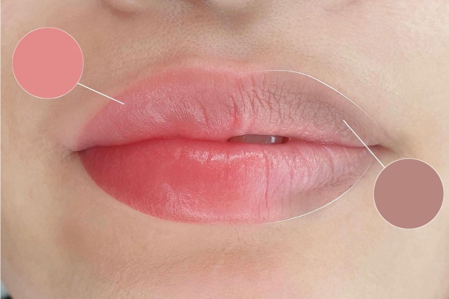 Vài ngày đầu sau điều trị, lớp da trong cùng (dermis) của bạn đang tái tạo collagen và elastin để lành lành mạnh.