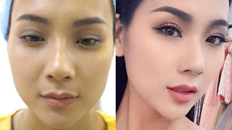 Quy trình cắt cánh mũi là phương pháp hoàn toàn không nguy hiểm