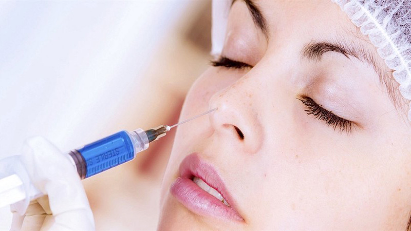 Chất làm đầy (filler) được tiêm vào và định hình dáng mũi